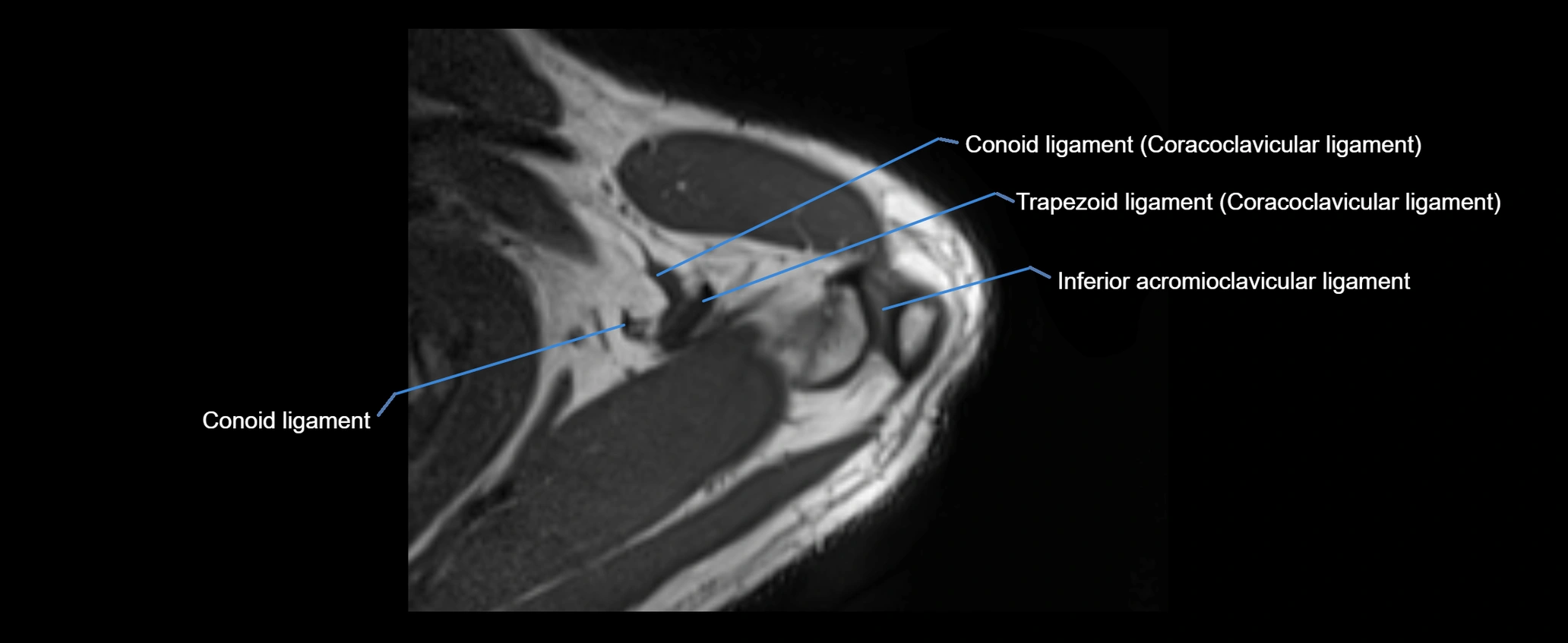 shoulder ligaments axial 3d 3t mri image-img-00005-00026.webp